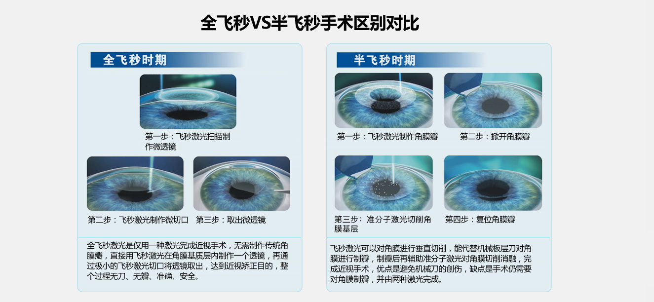 近视了怎么办 全飞秒激光近视手术 矫正近视方法 快速恢复视力